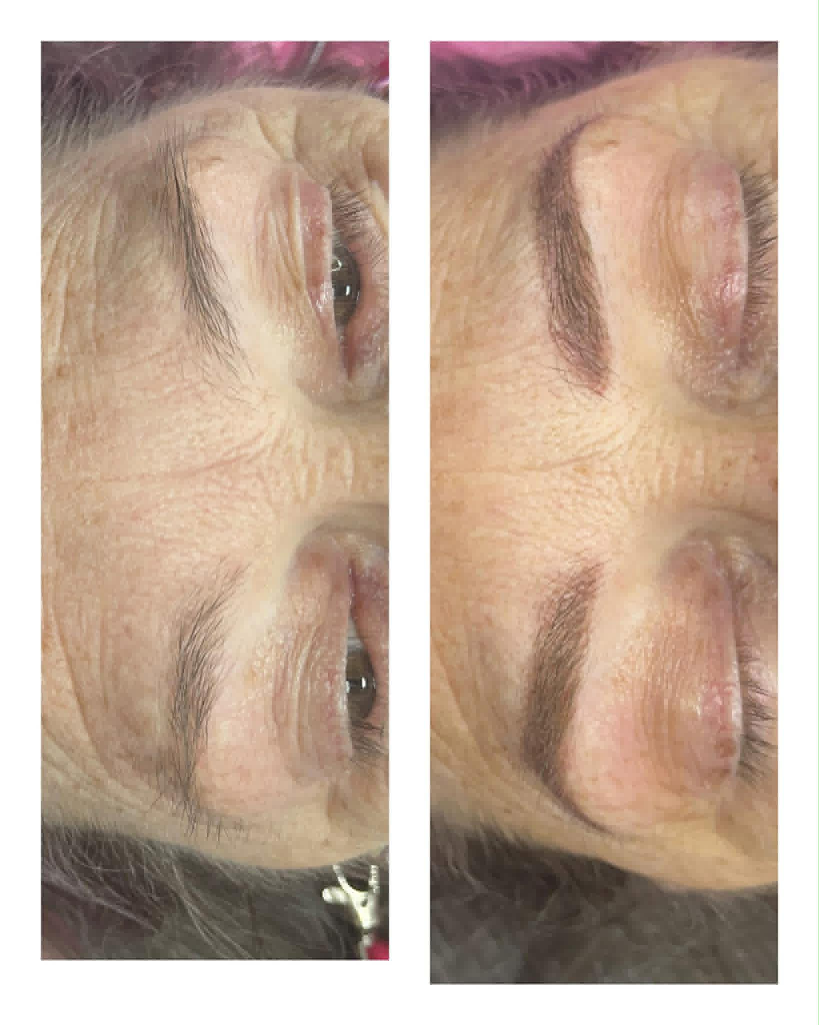 Natural brow restoration, before and after